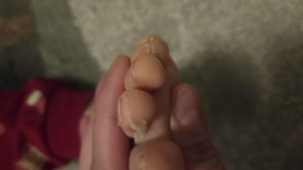 Bild zu Haut löst sich an Zehen - Haut von Babys und Kindern ✔️ Expertenforum