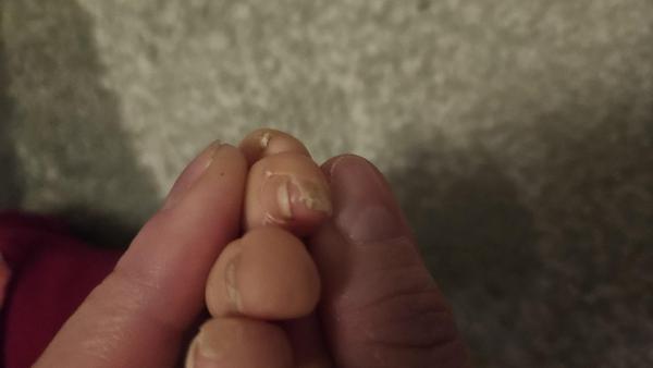 Bild zu Haut löst sich an Zehen - Haut von Babys und Kindern ✔️ Expertenforum