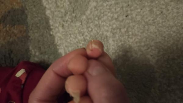 Bild zu Haut löst sich an Zehen - Haut von Babys und Kindern ✔️ Expertenforum