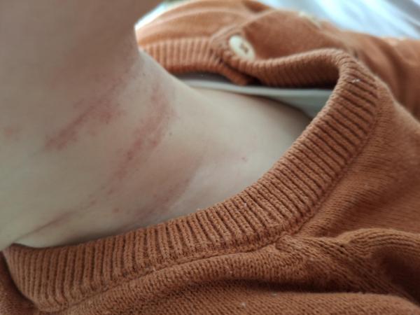 Bild zu Gerötete Hautfältchen Hals - Haut von Babys und Kindern ✔️ Expertenforum