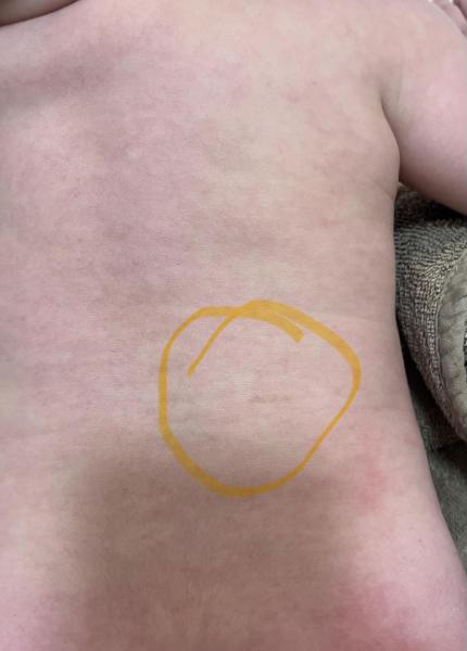 Bild zu Pigmentfleck - Haut von Babys und Kindern ✔️ Expertenforum