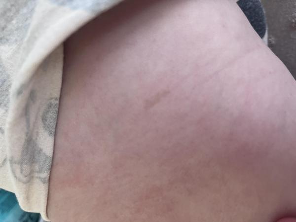 Bild zu Pigmentfleck - Haut von Babys und Kindern ✔️ Expertenforum