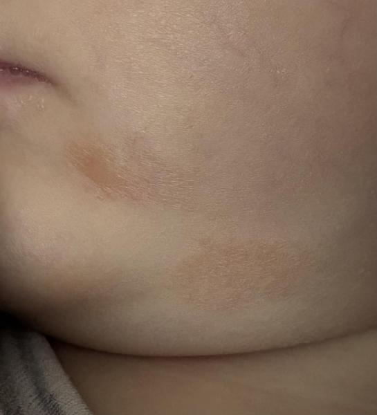 Bild zu Trockene Stellen im Gesicht - Haut von Babys und Kindern ✔️ Expertenforum