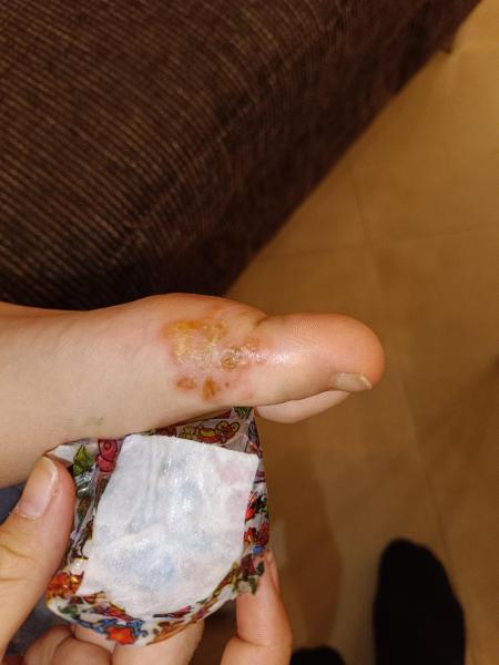 Bild zu Ausschlag am Fuß seitlich am Großen Zeh - Haut von Babys und Kindern ✔️ Expertenforum