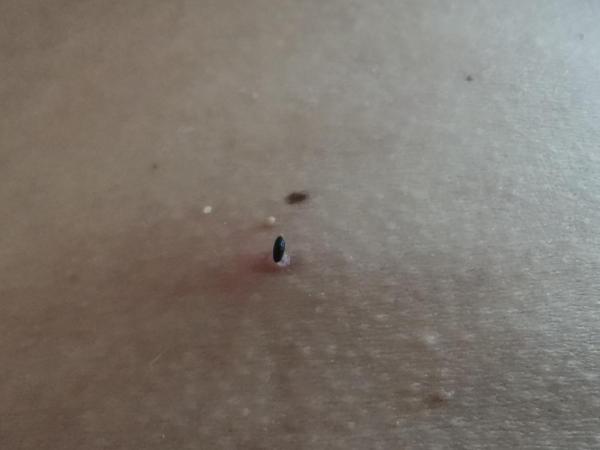 Bild zu Schwarzes Pünktchen - Haut von Babys und Kindern ✔️ Expertenforum