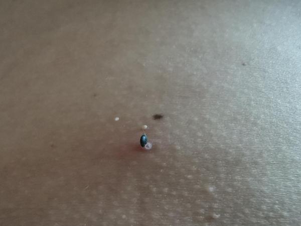 Bild zu Schwarzes Pünktchen - Haut von Babys und Kindern ✔️ Expertenforum