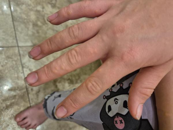 Bild zu Ausschlag am Fuß seitlich am Großen Zeh - Haut von Babys und Kindern ✔️ Expertenforum