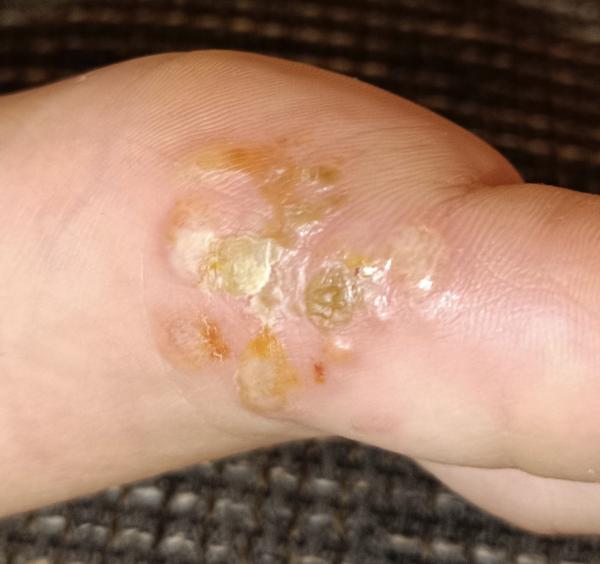 Bild zu Ausschlag am Fuß seitlich am Großen Zeh - Haut von Babys und Kindern ✔️ Expertenforum