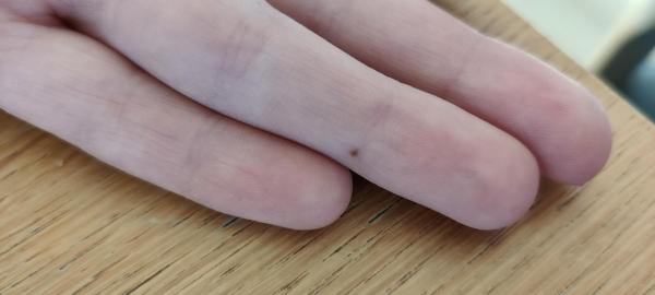 Bild zu Muttermal Ringfinger - Haut von Babys und Kindern ✔️ Expertenforum