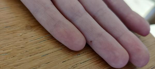 Bild zu Muttermal Ringfinger - Haut von Babys und Kindern ✔️ Expertenforum