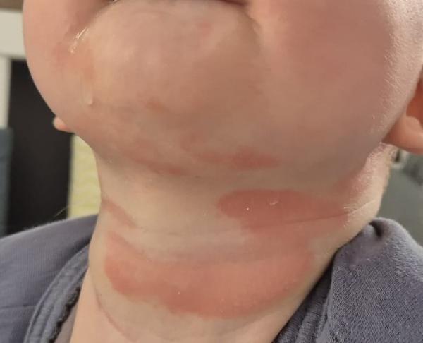 Bild zu Nummuläres Ekzem cortisonfreie Behandlung - Haut von Babys und Kindern ✔️ Expertenforum