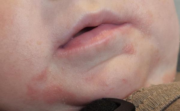 Bild zu Hautpilz Hals und unklare Hautveränderungen am Mund - Haut von Babys und Kindern ✔️ Expertenforum