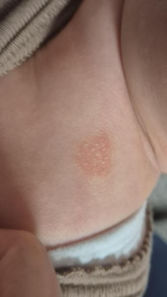 Bild zu Nummuläres Ekzem cortisonfreie Behandlung - Haut von Babys und Kindern ✔️ Expertenforum