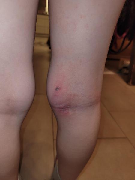 Bild zu Ausschlag in der Kniekehle - Haut von Babys und Kindern ✔️ Expertenforum