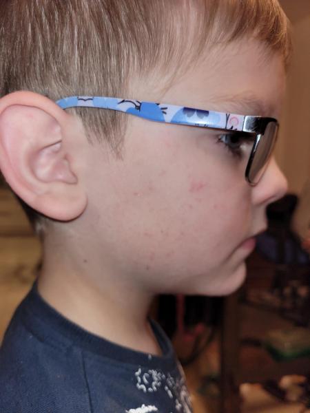 Bild zu Ausschlag in der Kniekehle - Haut von Babys und Kindern ✔️ Expertenforum