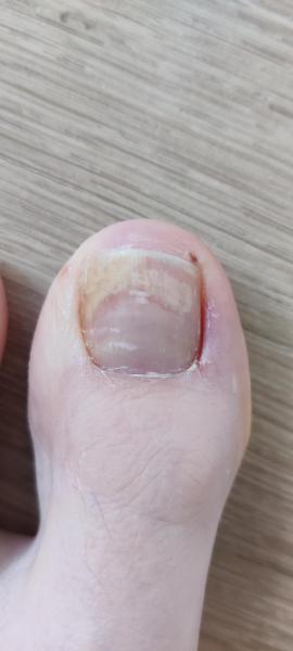 Bild zu Nageltrauma? - Haut von Babys und Kindern ✔️ Expertenforum