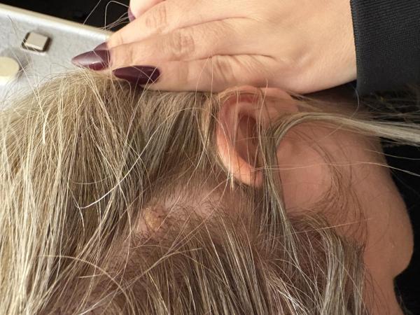 Bild zu Muttermal an der Kopfhaut ??? - Haut von Babys und Kindern ✔️ Expertenforum