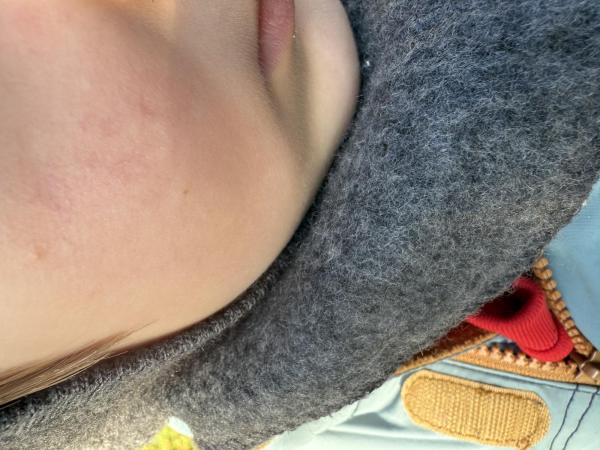 Bild zu Geplatzte Äderchen Wangen - Haut von Babys und Kindern ✔️ Expertenforum