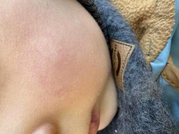 Bild zu Geplatzte Äderchen Wangen - Haut von Babys und Kindern ✔️ Expertenforum