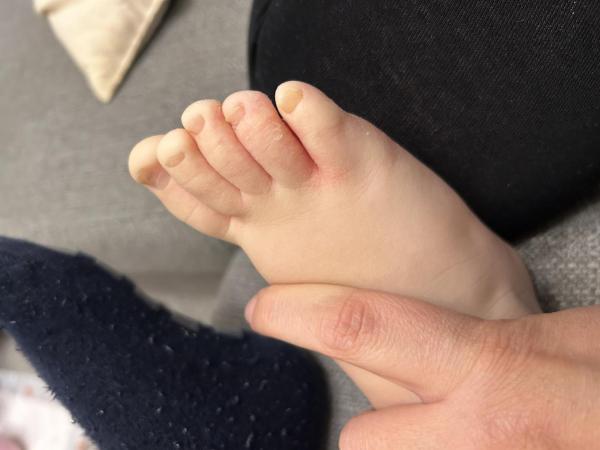 Bild zu Fussinfektion 3 Jahre / erneute Infektion ? - Haut von Babys und Kindern ✔️ Expertenforum