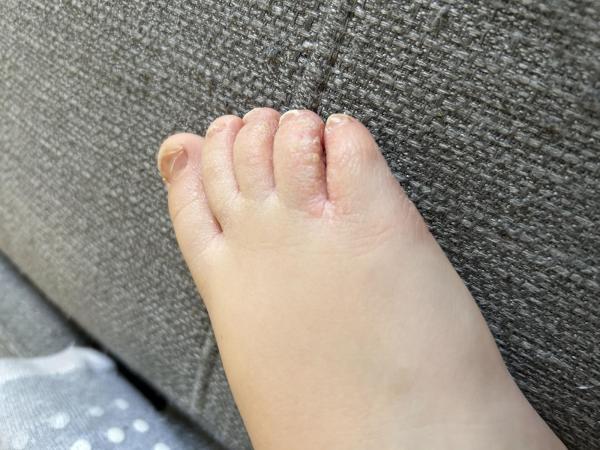 Bild zu Fussinfektion 3 Jahre / erneute Infektion ? - Haut von Babys und Kindern ✔️ Expertenforum