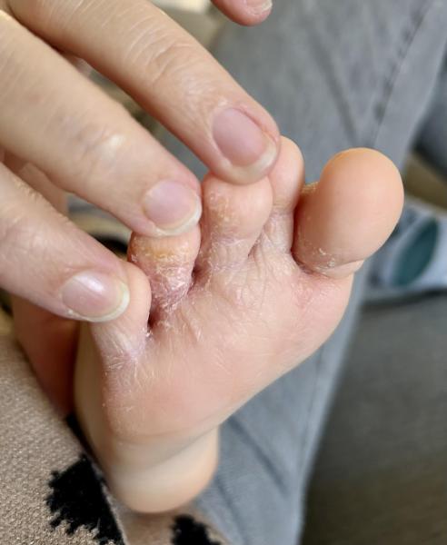 Bild zu Fussinfektion 3 Jahre / erneute Infektion ? - Haut von Babys und Kindern ✔️ Expertenforum