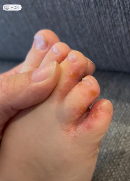 Bild zu Fussinfektion 3 Jahre / erneute Infektion ? - Haut von Babys und Kindern ✔️ Expertenforum