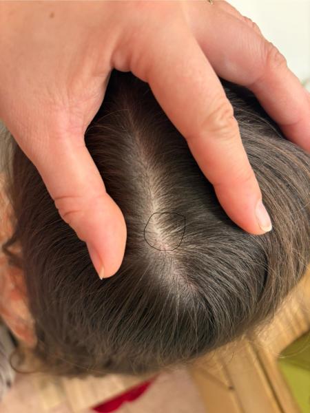 Bild zu Kleine kahle Stellen am Kopf - Haut von Babys und Kindern ✔️ Expertenforum