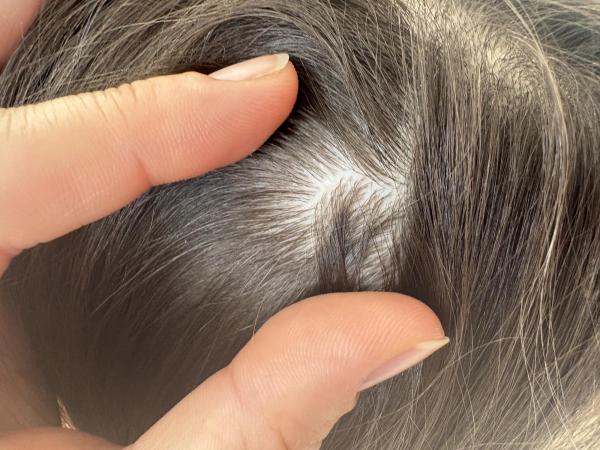 Bild zu Kleine kahle Stellen am Kopf - Haut von Babys und Kindern ✔️ Expertenforum