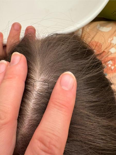 Bild zu Kleine kahle Stellen am Kopf - Haut von Babys und Kindern ✔️ Expertenforum