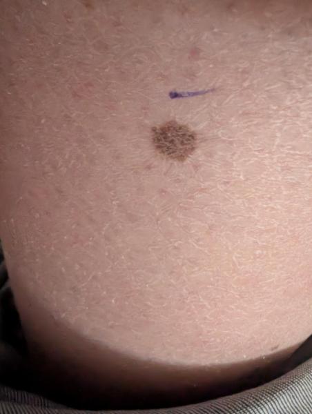 Bild zu Auffällige Leberflecken - Haut von Babys und Kindern ✔️ Expertenforum