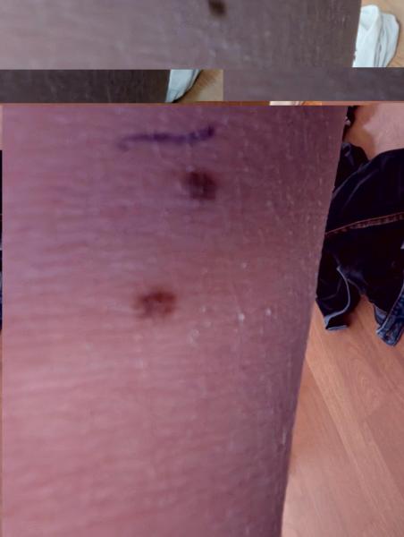 Bild zu Auffällige Leberflecken - Haut von Babys und Kindern ✔️ Expertenforum