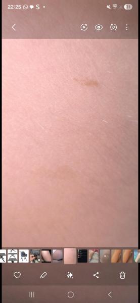 Bild zu Stielwarze Kind - Haut von Babys und Kindern ✔️ Expertenforum