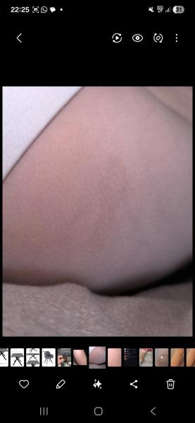 Bild zu Stielwarze Kind - Haut von Babys und Kindern ✔️ Expertenforum