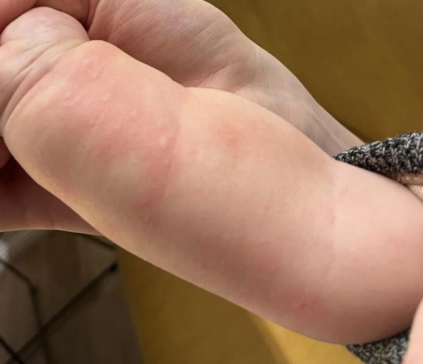 Bild zu Allergische Reaktion - Haut von Babys und Kindern ✔️ Expertenforum