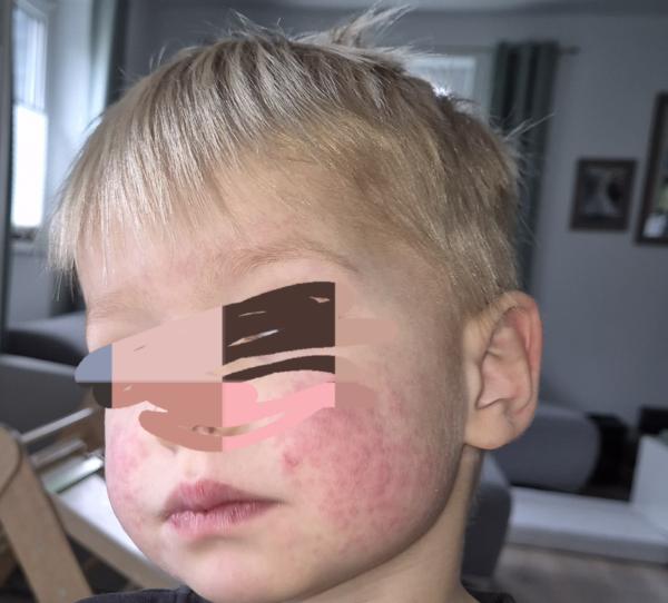 Bild zu Ausschlag Gesicht/Beine/Arme - Haut von Babys und Kindern ✔️ Expertenforum