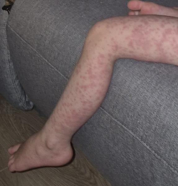 Bild zu Ausschlag Gesicht/Beine/Arme - Haut von Babys und Kindern ✔️ Expertenforum