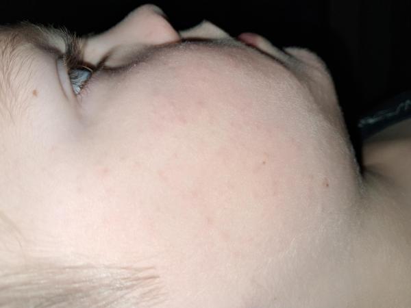 Bild zu Ausschlag bzw Pickelchen im Gesicht - Haut von Babys und Kindern ✔️ Expertenforum