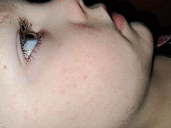 Bild zu Ausschlag bzw Pickelchen im Gesicht - Haut von Babys und Kindern ✔️ Expertenforum