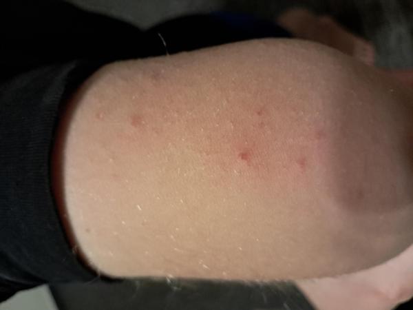 Bild zu Ausschlag bzw Pickelchen im Gesicht - Haut von Babys und Kindern ✔️ Expertenforum