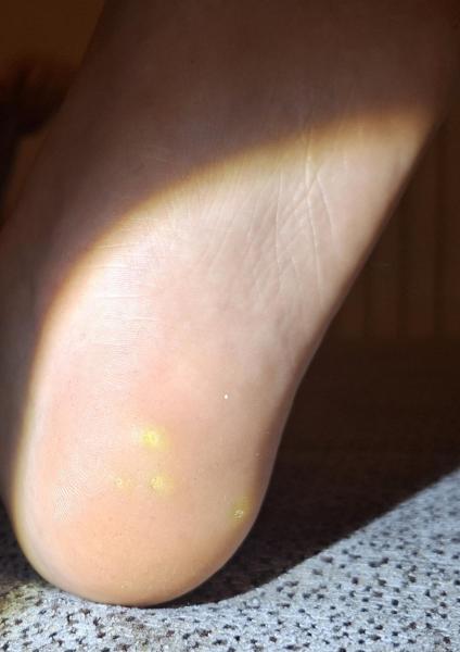 Bild zu Hühneraugen oder Warzen? - Haut von Babys und Kindern ✔️ Expertenforum