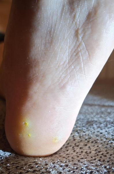 Bild zu Hühneraugen oder Warzen? - Haut von Babys und Kindern ✔️ Expertenforum