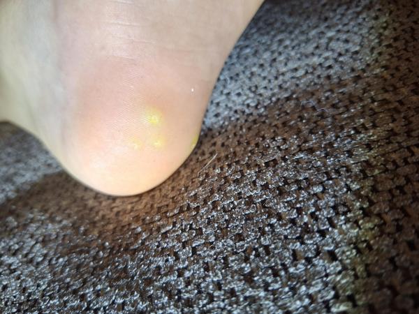 Bild zu Hühneraugen oder Warzen? - Haut von Babys und Kindern ✔️ Expertenforum