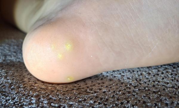 Bild zu Hühneraugen oder Warzen? - Haut von Babys und Kindern ✔️ Expertenforum