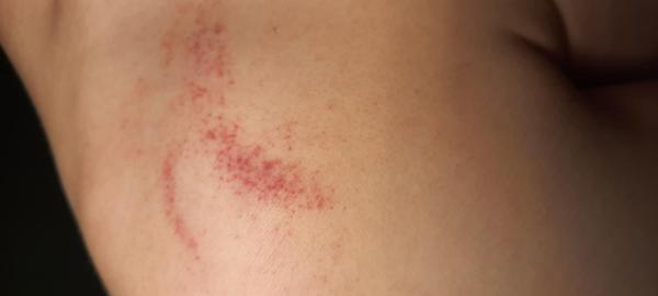 Bild zu Petechien? - Haut von Babys und Kindern ✔️ Expertenforum