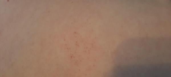 Bild zu Petechien? - Haut von Babys und Kindern ✔️ Expertenforum