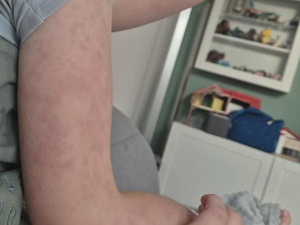 Bild zu Ausschlag Gesicht/Beine/Arme - Haut von Babys und Kindern ✔️ Expertenforum