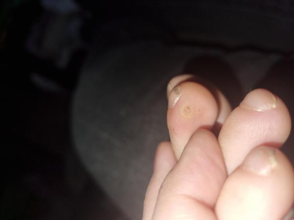 Bild zu Dornwarze? Form der Nägel - Haut von Babys und Kindern ✔️ Expertenforum