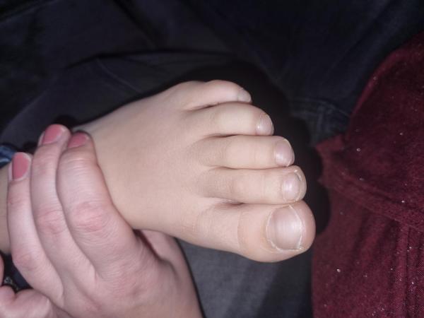 Bild zu Dornwarze? Form der Nägel - Haut von Babys und Kindern ✔️ Expertenforum