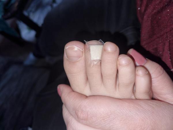 Bild zu Dornwarze? Form der Nägel - Haut von Babys und Kindern ✔️ Expertenforum